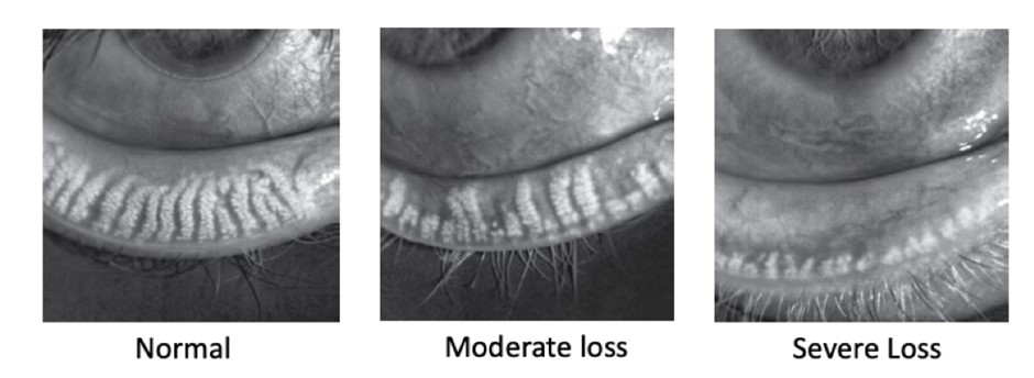 Infrared meibography images comparing normal meibomian glands, moderate gland loss and severe gland loss